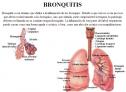 Bronquitis | Recurso educativo 27011